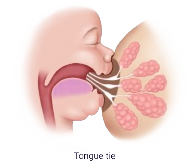Infant Tongue Tie Treatment